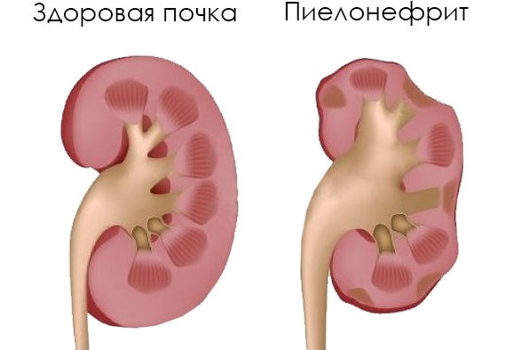 Эритроциты в моче у ребенка. Что это значит, норма, повышенные, неизменные