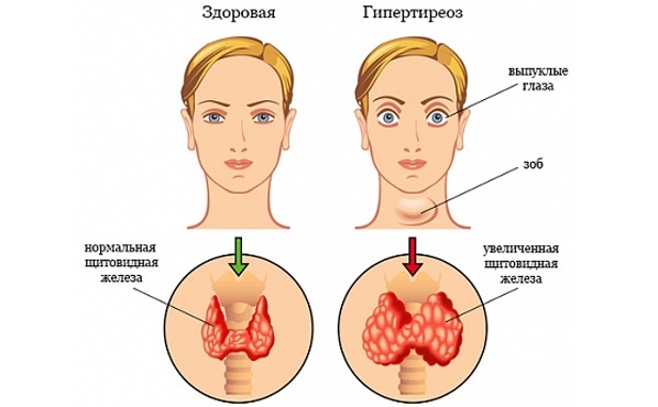 Гиперэстрогения у женщин. Симптомы, причины и лечение