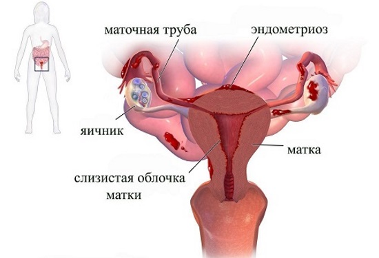 Гиперэстрогения у женщин. Симптомы, причины и лечение