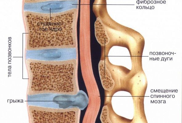 Грыжа позвоночника поясничного отдела. Симптомы, лечение упражнениями Бубновского и другие методы
