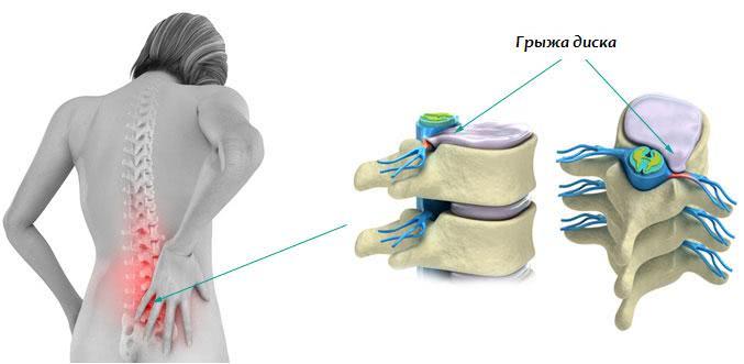 Грыжа позвоночника поясничного отдела. Симптомы, лечение упражнениями Бубновского и другие методы