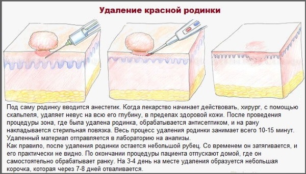 Красные родинки на теле у мужчин и женщин. Что это значит, причины и лечение