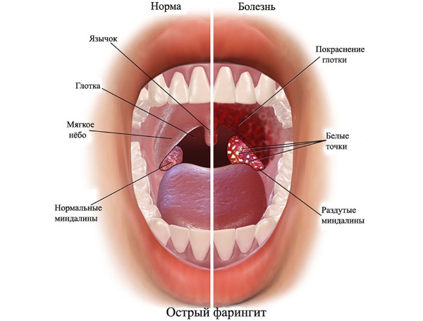 Лечение горла у ребенка, взрослого быстро и эффективно. Народные средства, лекарства