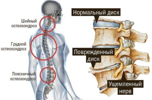 Лечение остеохондроза шейного отдела в домашних условиях мазями, ЛФК, народные средства, процедуры