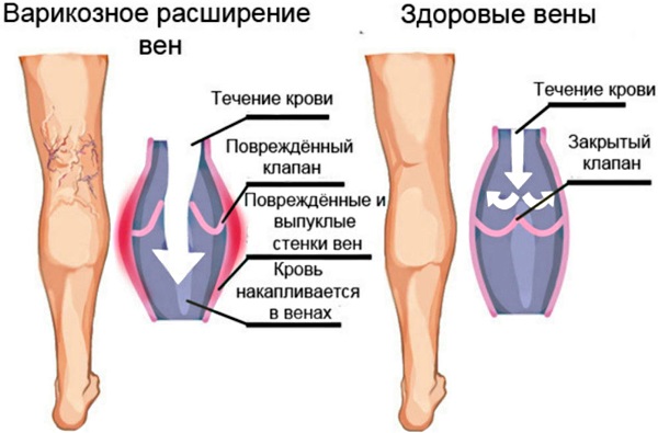 Мази от варикоза вен на ногах. Список, цены, лучшие при беременности