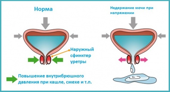 Недержание мочи у мужчин. Причины и лечение. Препараты в таблетках, народные средства