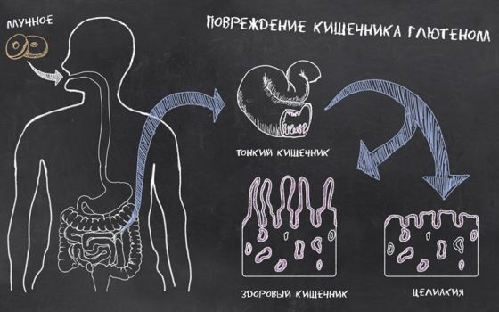 Непереносимость глютена. Симптомы у взрослых, диагностика и лечение, диета