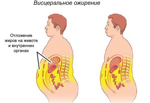 Ожирение 1-2-3 степени у женщин, мужчин, детское. Типы, стадии. Причины, симптомы, лечение