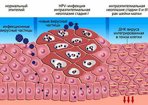 Папилломавирус у женщин в гинекологии. Причины, симптомы, лечение