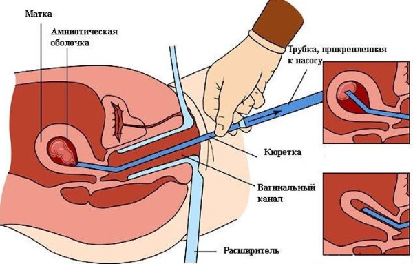 Прерывание беременности на ранних сроках. Таблетки, народные средства, процедуры