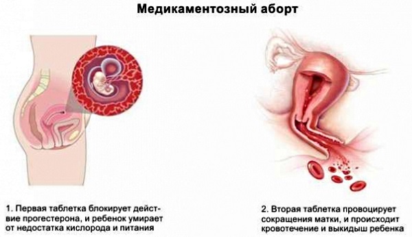 Прерывание беременности на ранних сроках. Таблетки, народные средства, процедуры