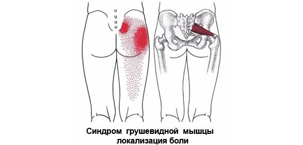 Как вылечить грушевидную мышцу