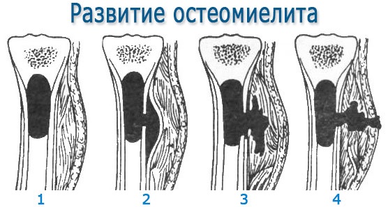 Боль под левой грудиной у женщин спереди при дыхании, движении, нажатии, после еды. Причины и что делать