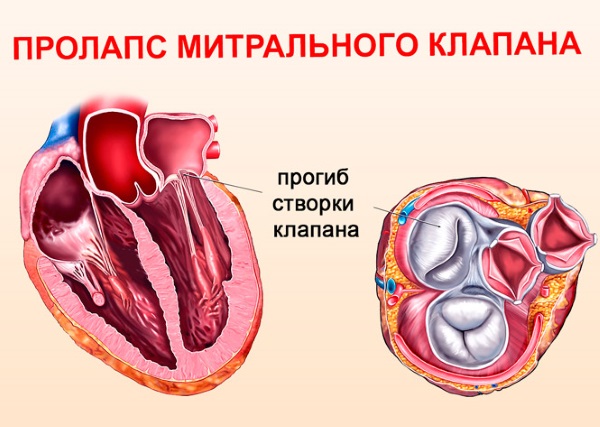 Боль под левой грудью у женщин: что находится и может колоть слева в грудине