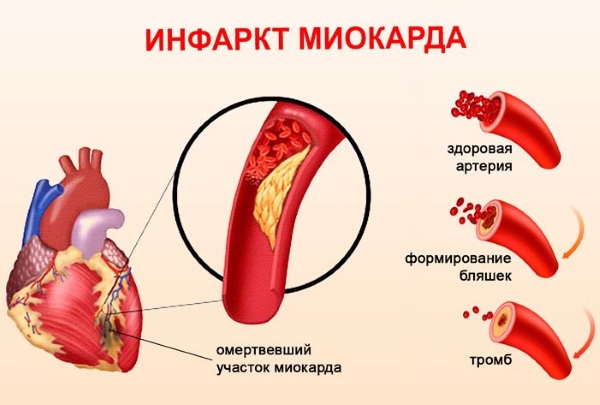 Боль под левой грудиной у женщин спереди при дыхании, движении, нажатии, после еды. Причины и что делать