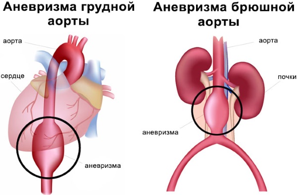 Боль под левой грудиной у женщин спереди при дыхании, движении, нажатии, после еды. Причины и что делать