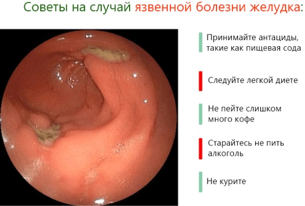 Боли в спине в области лопаток. Причины, лечение – препараты и упражнения