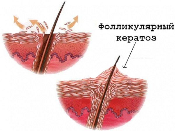 Фолликулярный кератоз у ребенка. Признаки, фото, симптомы и лечение