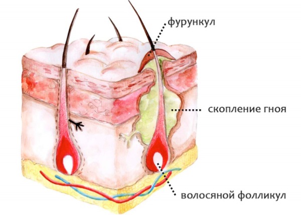 Фурункул на лице, в ухе, носу. Лечение в домашних условиях, народные средства, препараты