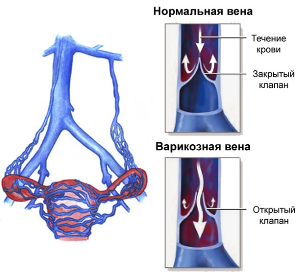 Хронический аппендицит у женщин. Симптомы, диагностика, лечение