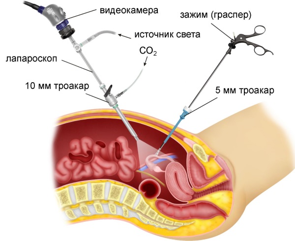 Симптом Кохера при аппендиците. Что это, механизм возникновения