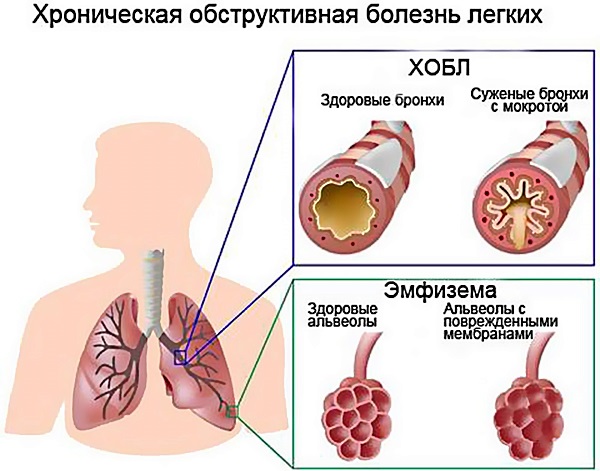 Хронический бронхит. Симптомы, лечение, клинические рекомендации. Возможные осложнения