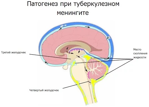 Менингит. Симптомы у взрослых, как распознать, признаки, причины возникновение, анализы, лечение