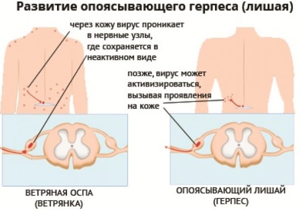 Опоясывающий лишай у детей. Симптомы, лечение, стадии, мази, уход за больным