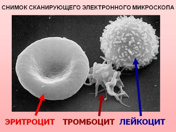 Повышенное содержание лейкоцитов в крови у мужчин, женщин, ребенка. Причины и что делать