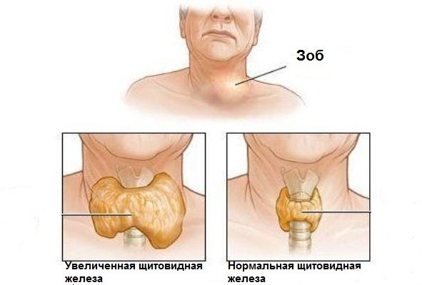 Проблемы с щитовидной железой у женщин и мужчин. Симптомы и лечение