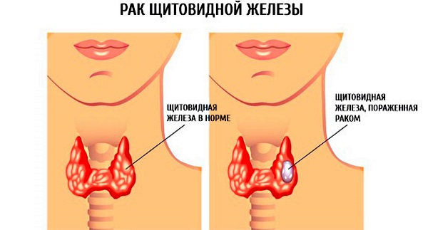 Проблемы с щитовидной железой у женщин и мужчин. Симптомы и лечение