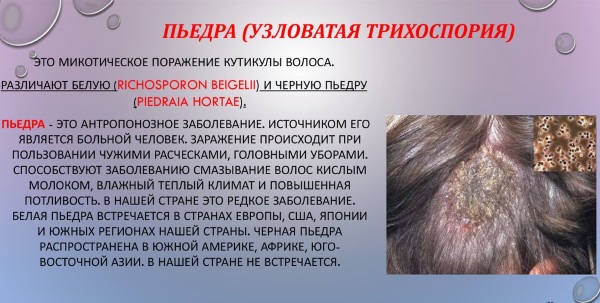 Разновидности лишая у человека. Фото, описание, симптомы и лечение