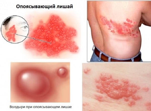 Разновидности лишая у человека. Фото, описание, симптомы и лечение