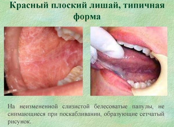 Разновидности лишая у человека. Фото, описание, симптомы и лечение