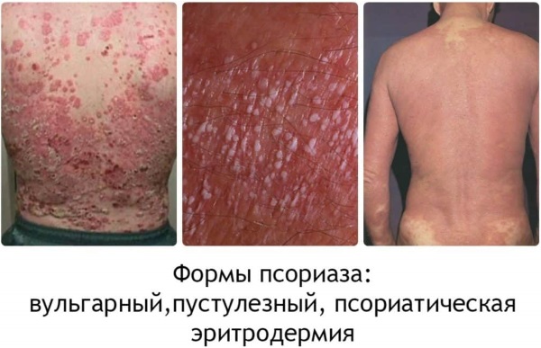 Разновидности лишая у человека. Фото, описание, симптомы и лечение