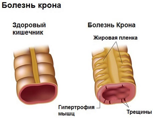 Слизь в кале у взрослого. Что это может быть, причины и лечение