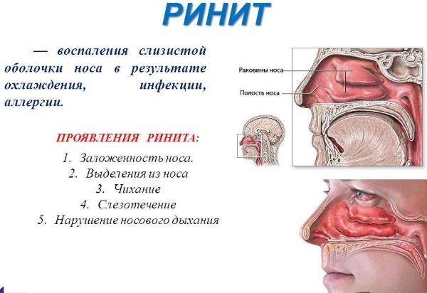 Слизь в кале у взрослого. Что это может быть, причины и лечение