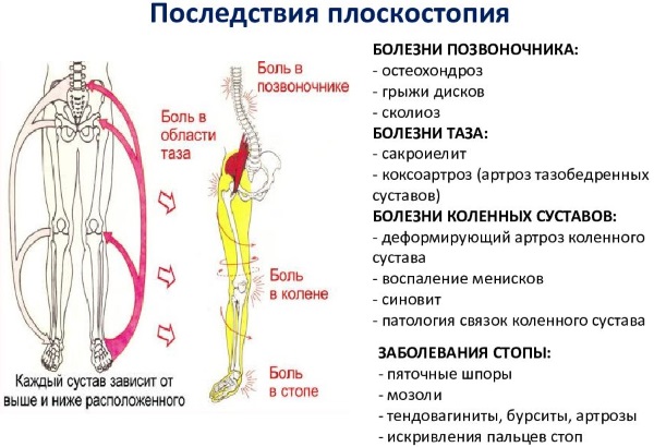 Ступни ног болят у женщин. Строение, симптомы вывиха, артроз, что делать, если опухла, немеет. Диагностика заболеваний, лечение