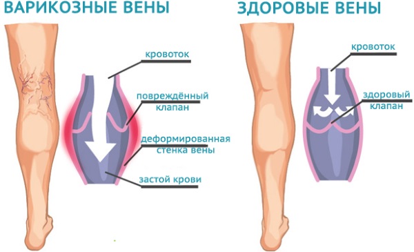 УЗДГ вен нижних конечностей. Что это, подготовка к процедуре, где сделать, цены в Москве