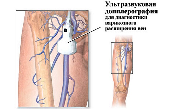 УЗДГ вен нижних конечностей. Что это, подготовка к процедуре, где сделать, цены в Москве