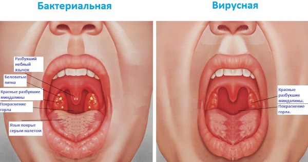 Антибиотики при ангине у взрослого. Список препаратов в таблетках, без рецептов, цены