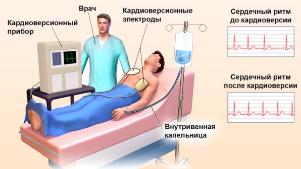 Аритмия сердца. Чем опасна, причины, симптомы, как лечить в домашних условиях