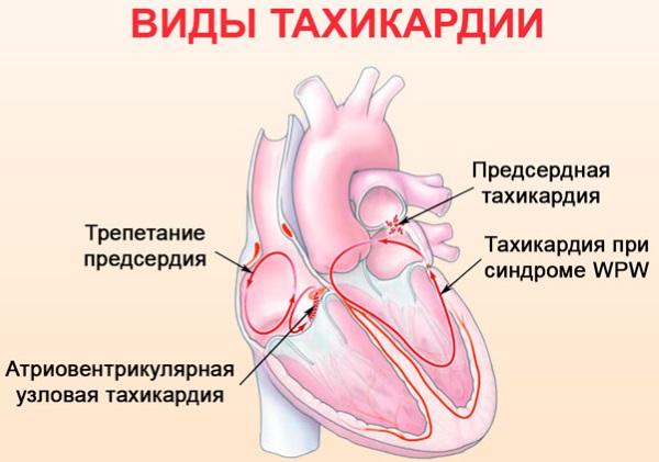 Аритмия сердца. Чем опасна, причины, симптомы, как лечить в домашних условиях