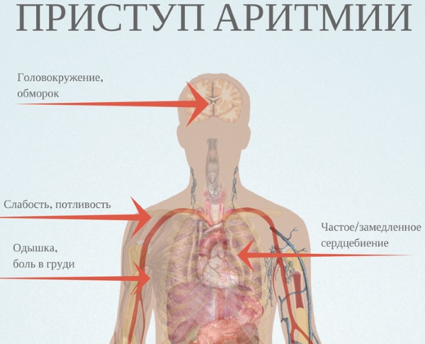 Аритмия сердца. Симптомы, лечение, первая помощь