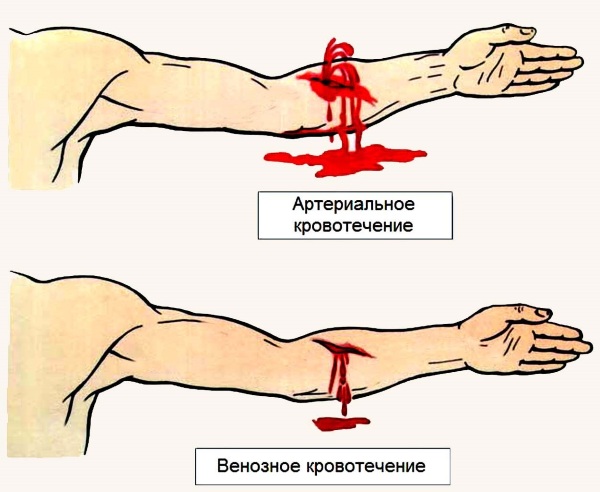 Артериальное кровотечение. Признаки, помощь, почему возникает, чем характеризуется. Советы врачей