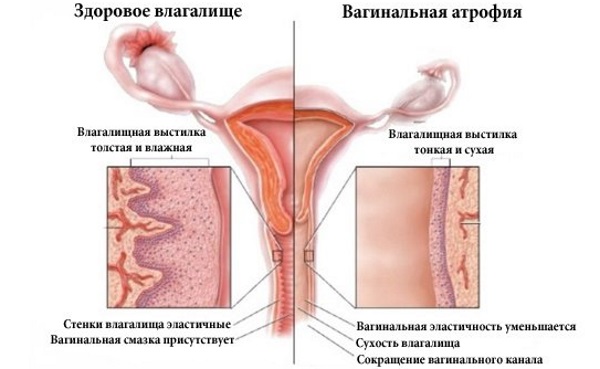 Восстановление слизистой влагалища при менопаузе