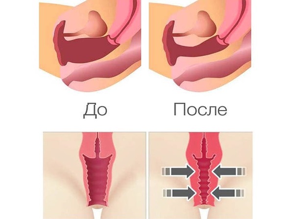 Атрофия слизистой в гинекологии. Лечение народными средствами, препараты, свечи. Симптомы