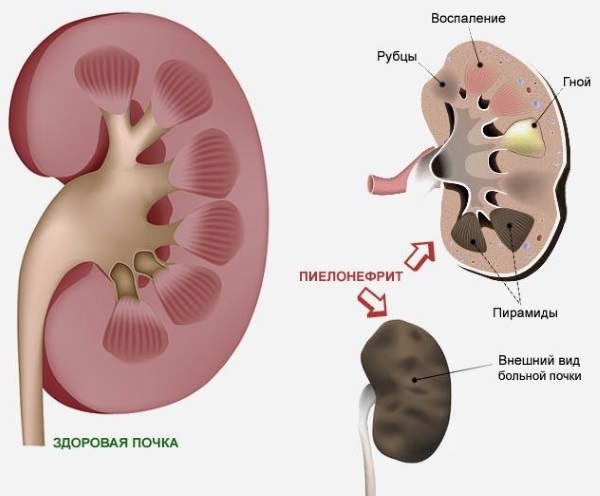 Болит почка с левой стороны. Что это может быть, причины, симптомы и лечение