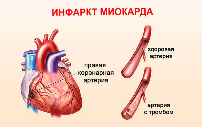 Болит подмышка слева, справа у женщин. Причины и как избавиться