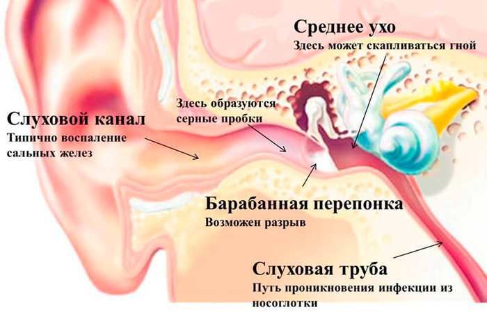 Болит ухо с одной стороны. Чем лечить: лекарства, антибиотики, капли